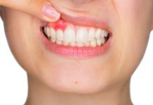 periodontitis