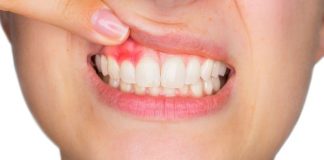 periodontitis