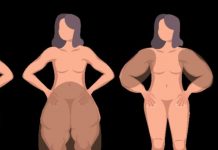 Lipedema