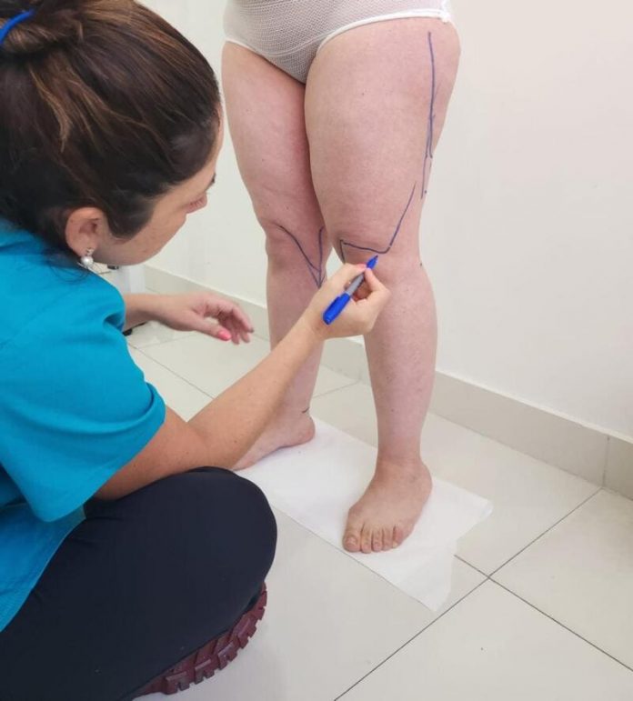 LIPEDEMA TRES GOOGLE (1) Lipedema